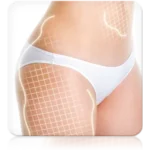 Lipocavitazione