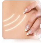 Iontophoresis